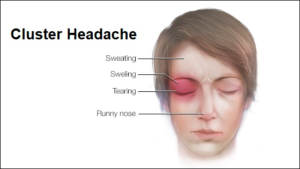 What Does a Right-Sided Headache Mean?